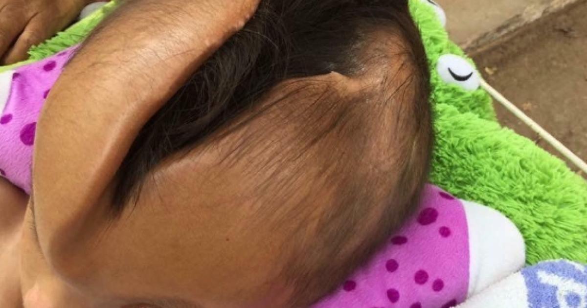 Vive con un buco in testa esiste una cura per il piccolo Pheaktra?