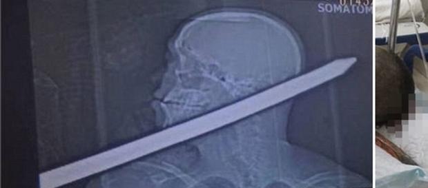 Na imagem é possível ver um exame de imagem mostrando o tubo de ferro. Na imagem é possível ver um exame de imagem mostrando o tubo de ferro.