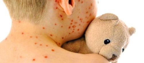 Allarme morbillo in Italia, a Pescara è epidemia 25 casi. Colpito ... - fanpage.it