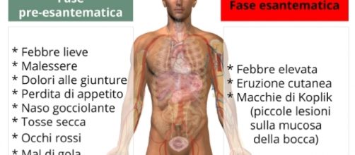 Torna il morbillo e può avere conseguenze letali