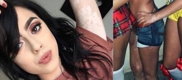 Mulher dá a volta por cima e não deixa doença de pele abalar sua autoestima. Mulher dá a volta por cima e não deixa doença de pele abalar sua autoestima.