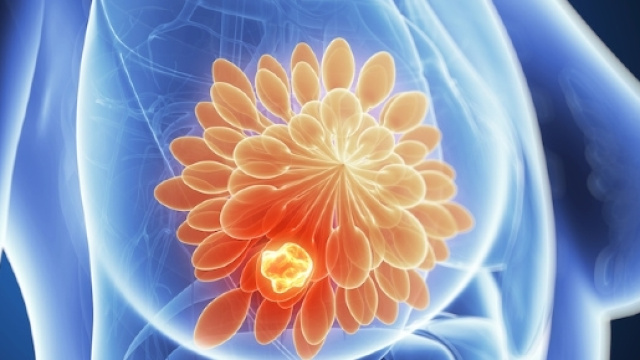 Tumore al seno, scoperta proteina in grado di limitare la crescita ... - improntaunika.it