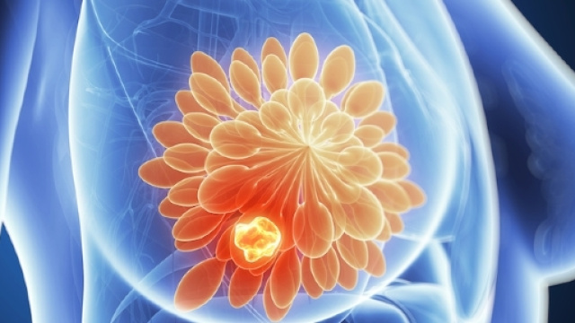 Un grafico che esprime un tumore mammario