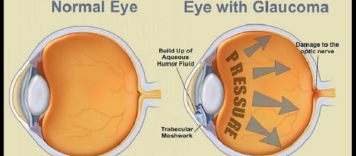 Una diagnosi precoce di glaucoma può salvare la vista.