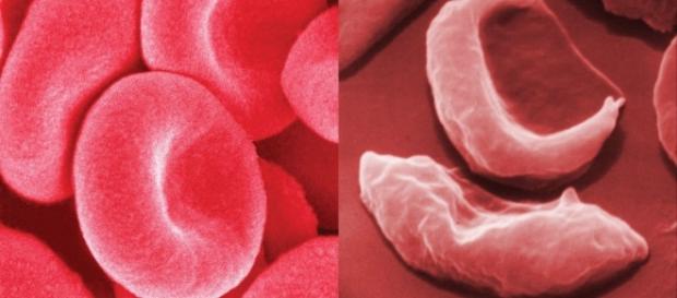 Anemia falciforme, ragazzo guarito grazie a terapia genica - healthclinicweb.com Anemia falciforme, ragazzo guarito grazie a terapia genica - healthclinicweb.com