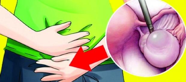 Sinais de cisto no ovário aos quais toda mulher deve ficar atenta Sinais de cisto no ovário aos quais toda mulher deve ficar atenta