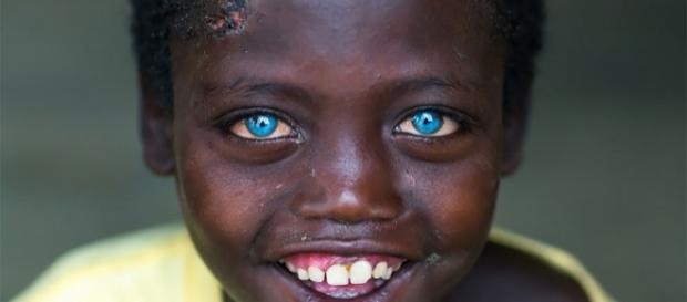 Abushe, a criança africana com olhos azuis Abushe, a criança africana com olhos azuis