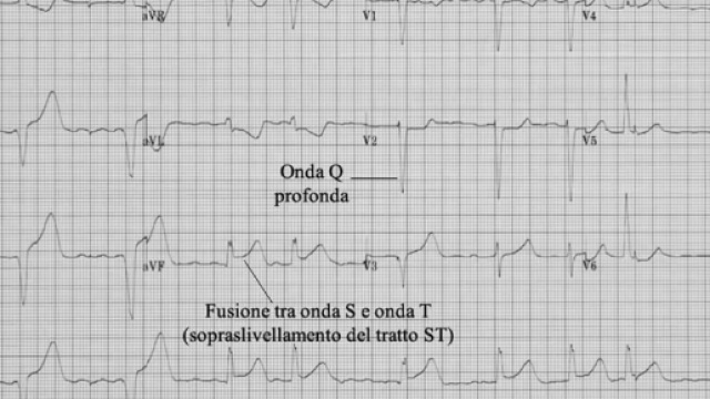 la diagnostica per l'infarto ora &egrave; pi&ugrave; veloce