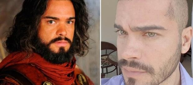 Sidney Sampaio, antes e depois: procedimento realizado com sucesso Sidney Sampaio, antes e depois: procedimento realizado com sucesso