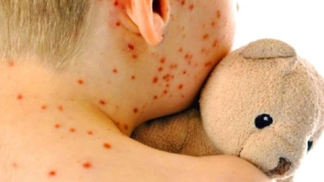 morbillo, oltre mille casi da gennaio 2017