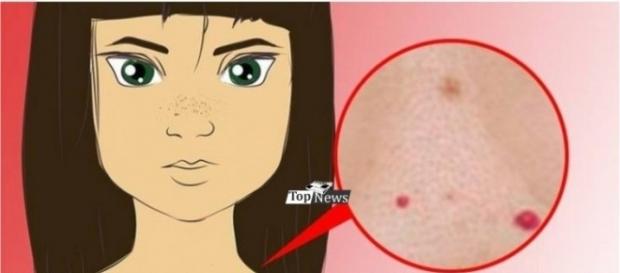 Veja o que pode ser as manchas vermelhas em seu corpo Veja o que pode ser as manchas vermelhas em seu corpo