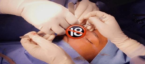 Eddy se faire opérer d'une rhinoplastie en Tunisie Eddy se faire opérer d'une rhinoplastie en Tunisie
