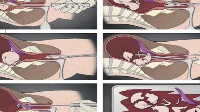 Se l'aborto &egrave; effettuato dopo il secondo mese di gestazione per estrarlo il feto viene smembrato.