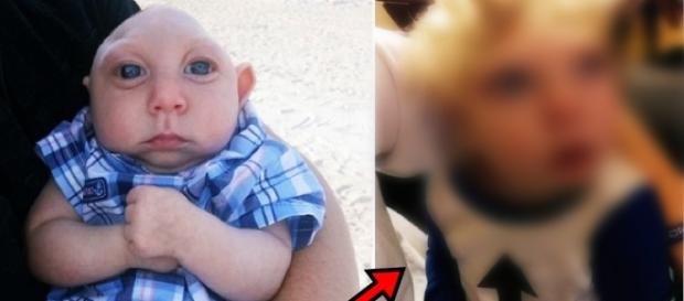 Menino que nasceu sem metade da cabeça sobrevive Menino que nasceu sem metade da cabeça sobrevive
