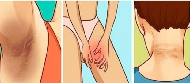Dicas para acabar com manchas na pele Dicas para acabar com manchas na pele
