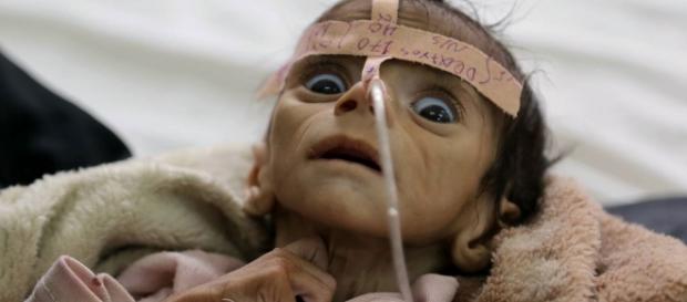 a terrível realidade dos bebês no Yemen a terrível realidade dos bebês no Yemen