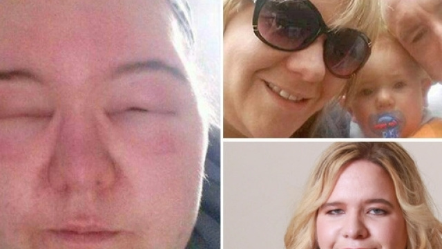 Volto gonfio come un pallone dopo la tintura per capelli