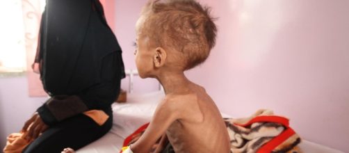 Yemen, 432mila casi di bambini malnutriti a causa della guerra e della carestia