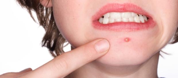 Tratamento com chás naturais contra a acne Tratamento com chás naturais contra a acne