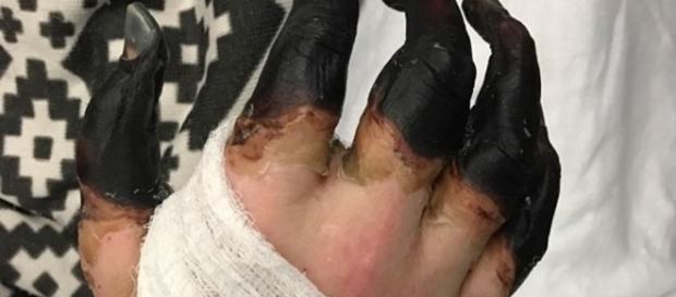 Na imagem os membros do homem já necrosados pela infecção, e a ponto de serem amputados. Na imagem os membros do homem já necrosados pela infecção, e a ponto de serem amputados.