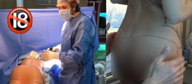 Kim Glow se fait liposucer et réinjecter sa graisse dans les fesses devant la caméra de Sam Zirah Kim Glow se fait liposucer et réinjecter sa graisse dans les fesses devant la caméra de Sam Zirah