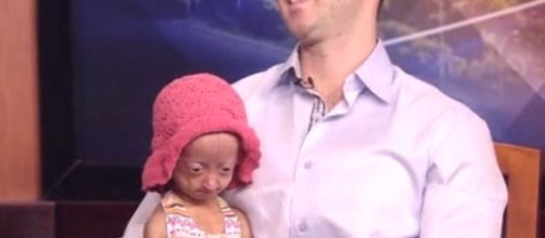 La bambina "vecchia per sempre", colpita dalla Progeria sin dalla nascita