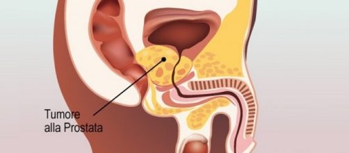 Le nuove linee guida limitano molto il dosaggio del PSA come metodo di screening del tumore alla prostata.