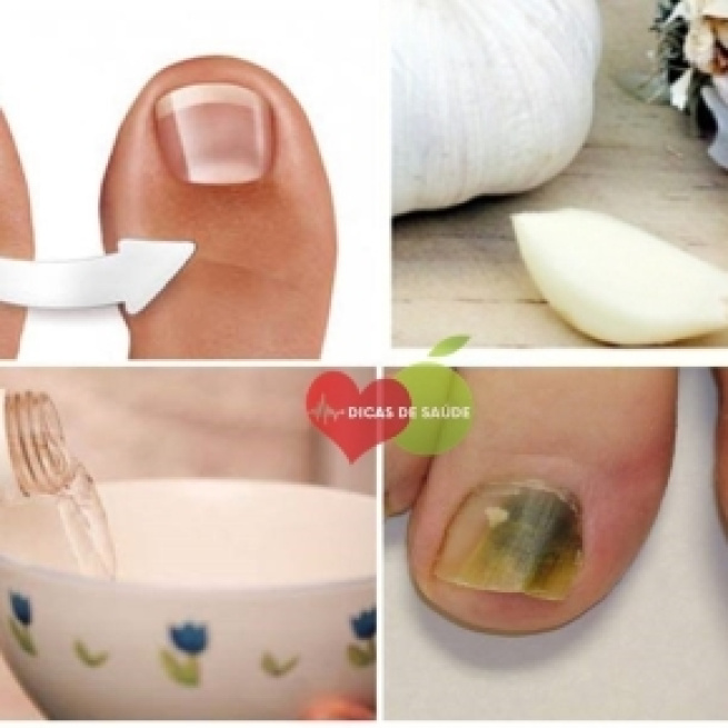 Saiba como se livrar dos fungos nas unhas com apenas 3 ingredientes