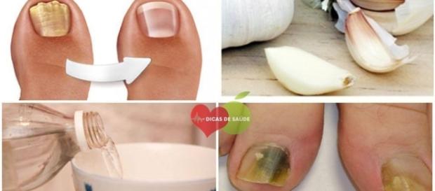 Saiba como se livrar dos fungos nas unhas com apenas 3 ingredientes Saiba como se livrar dos fungos nas unhas com apenas 3 ingredientes
