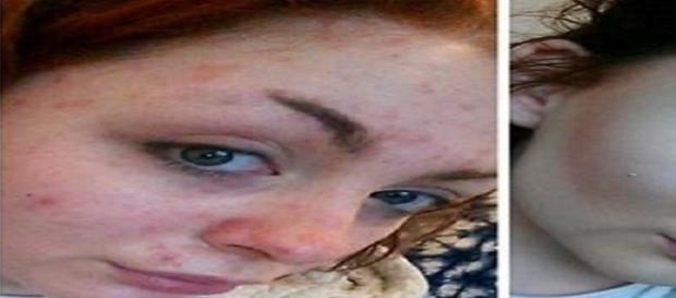 Sophia sofre de psoríase e seu namorado terminou com ela ao vê-la sem maquiagem Sophia sofre de psoríase e seu namorado terminou com ela ao vê-la sem maquiagem