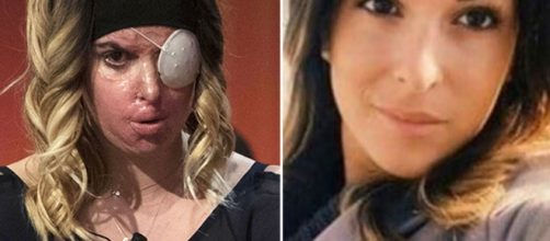 Former beauty queen Gessica Notaro reveals acid attack scars on ... - com.au