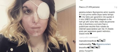 Il nuovo account Instagram di Gessica Notaro sfregiata dall'ex fidanzat è un modo per accettare la realtà e tornare a vivere