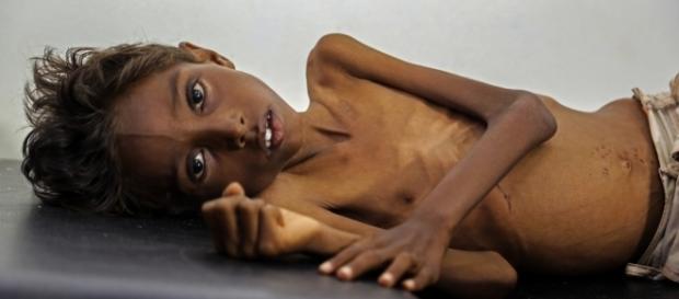 Enfant malnutri au Yémen, Huffingtonpost Enfant malnutri au Yémen, Huffingtonpost