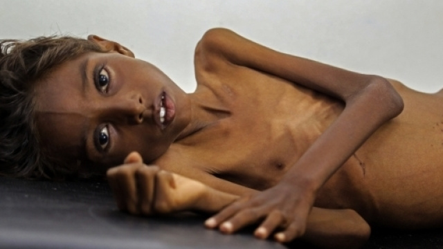 Enfant malnutri au Yémen, Huffingtonpost