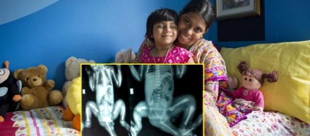 Veja como está a menina de Bangladesh que nasceu com três pernas após a cirurgia Veja como está a menina de Bangladesh que nasceu com três pernas após a cirurgia
