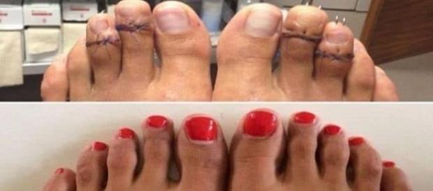 La chirurgie Cendrillon pour raccourcir les pieds devient très tendance aux Etats-Unis La chirurgie Cendrillon pour raccourcir les pieds devient très tendance aux Etats-Unis