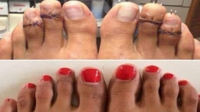 La chirurgie Cendrillon pour raccourcir les pieds devient très tendance aux Etats-Unis