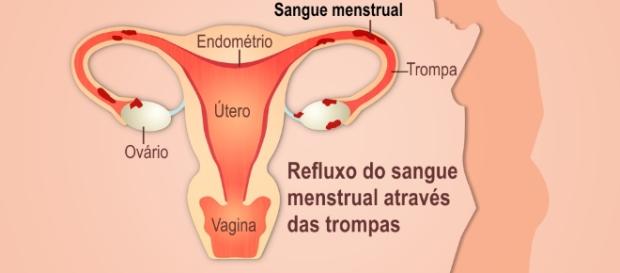 O que você precisa saber sobre a endemetriose O que você precisa saber sobre a endemetriose