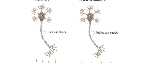 FDA approva Ocrevus (ocrelizumab), un anticorpo monoclonale per la sclerosi multipla.