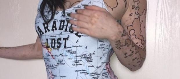 Uma doença, virando arte no corpo dessa jovem. Uma doença, virando arte no corpo dessa jovem.