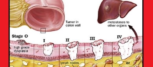 Dal 1 gennaio 2018 verrà introdotto una nuova classificazione dei tumori, che andrà a sostituire l’attuale basata sul sistema TNM.