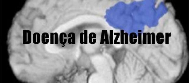 Doença de alzheimer não tem cura. Doença de alzheimer não tem cura.