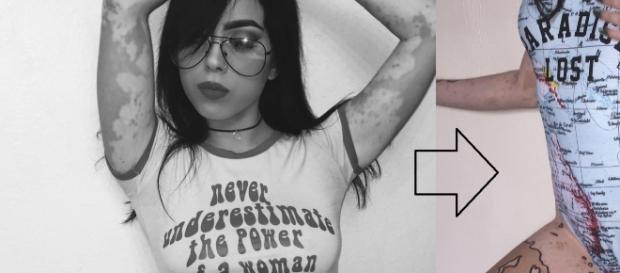 Como o Instagram fez Ash Soto superar o vitiligo e o bullying. Confira Como o Instagram fez Ash Soto superar o vitiligo e o bullying. Confira
