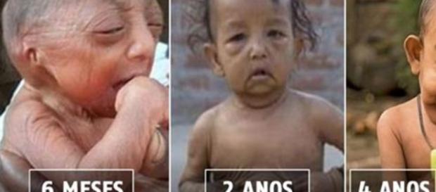 Com apenas quatro anos, este garotinho de Bangladesh foi apelidado de “Benjamin Button” (Foto: Google) Com apenas quatro anos, este garotinho de Bangladesh foi apelidado de “Benjamin Button” (Foto: Google)