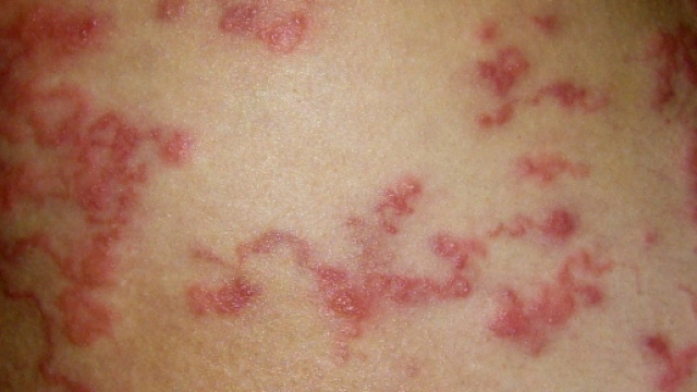 Larva migrans cutanea: colpita donna americana, il caso finisce sul Journal of Emergency Medicine