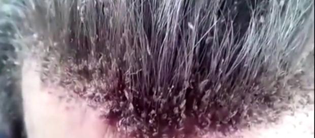 Impressionante infestação de piolhos. Impressionante infestação de piolhos.