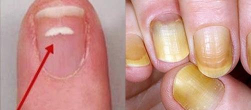 Manchas ou amarelamento das unhas podem indicar problemas de saúde