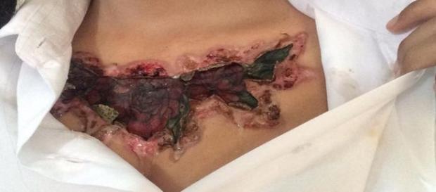O resultado da remoção de tatuagem foi assustador e a jovem não recomenda o tratamento para ninguém (Foto: Reprodução/ The Mirror) O resultado da remoção de tatuagem foi assustador e a jovem não recomenda o tratamento para ninguém (Foto: Reprodução/ The Mirror)