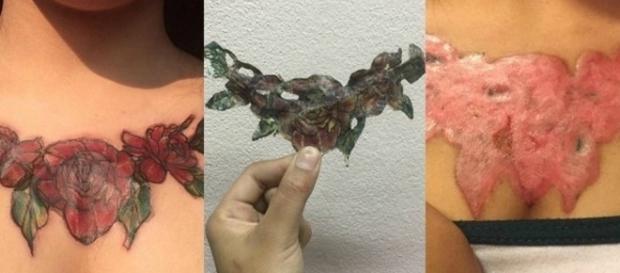 O resultado da remoção de tatuagem não foi o esperado O resultado da remoção de tatuagem não foi o esperado