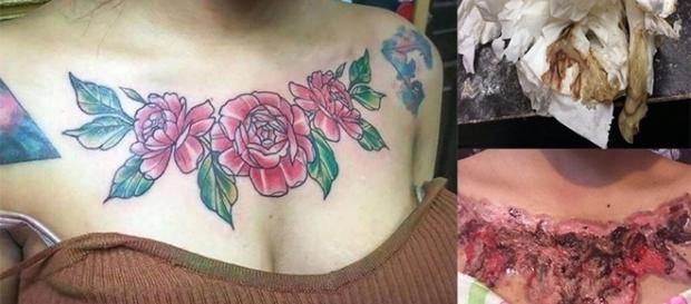 Remoção de tatuagem deixa fortes marcas Remoção de tatuagem deixa fortes marcas